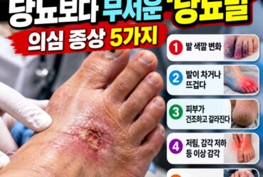 당뇨병 환자라면 발부터 확인하세요! 절단까지 부르는 '당뇨발' 위험 신호 5가지