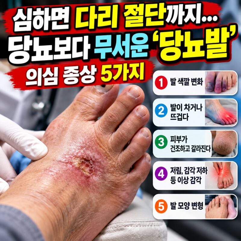 당뇨병 환자라면 발부터 확인하세요! 절단까지 부르는 '당뇨발' 위험 신호 5가지
