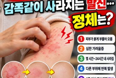 모기 물린 줄 알았는데 몇 시간 뒤 사라졌다? 가을철 '두드러기' 원인과 증상, 치료법 총정리