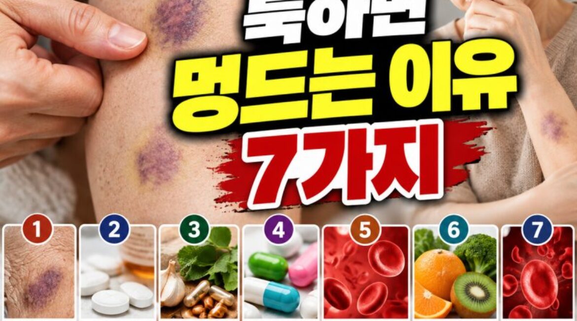 부딪힌 기억도 없는데 멍이 생긴다? 쉽게 멍드는 이유 7가지와 대처법