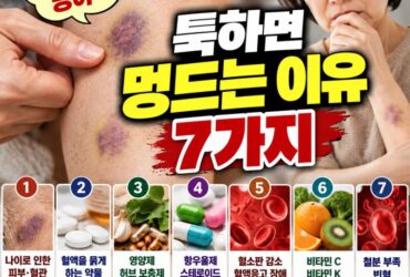 부딪힌 기억도 없는데 멍이 생긴다? 쉽게 멍드는 이유 7가지와 대처법