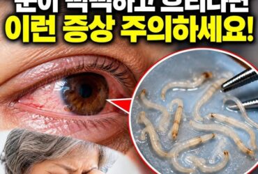“눈이 뻑뻑해 안구건조증인 줄 알았는데…” 70대 양쪽 눈에서 기생충 11마리 발견, 이런 증상 있다면 주의!