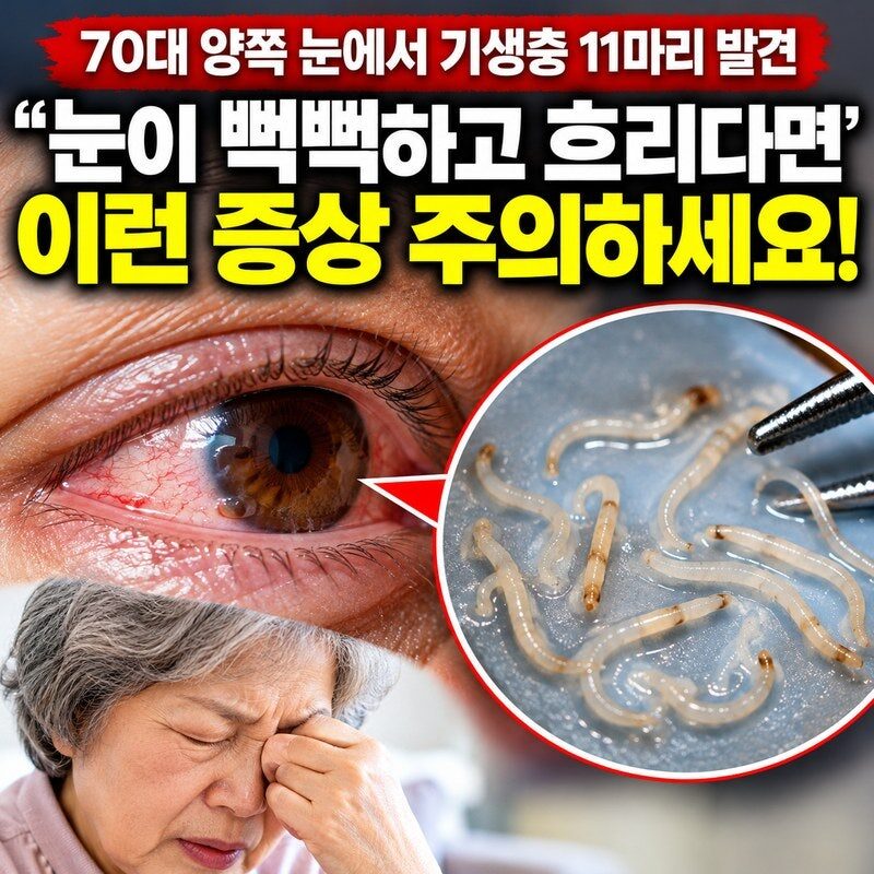 “눈이 뻑뻑해 안구건조증인 줄 알았는데…” 70대 양쪽 눈에서 기생충 11마리 발견, 이런 증상 있다면 주의!